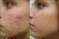 /album/fotogalerie-chemicky-peeling/chemical-peeling-before-after-jpg/
